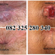 Illustration for article titled obat wasir tanpa operasi